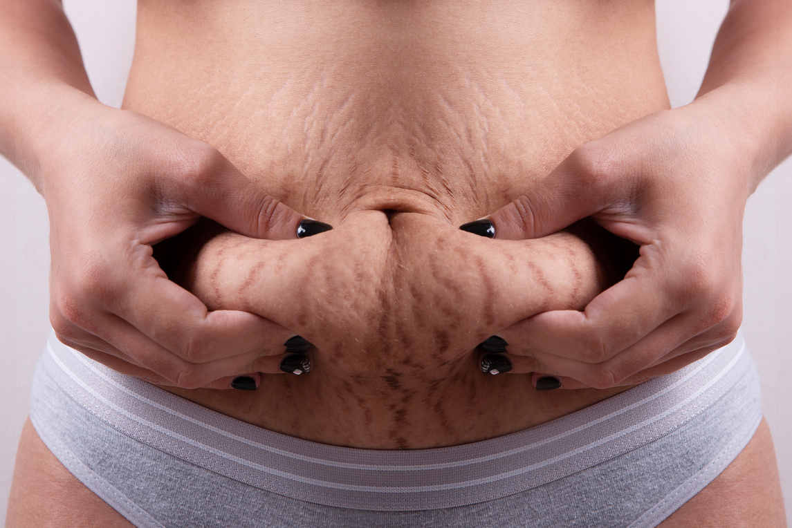 Woman Pinching Stomach Fat 